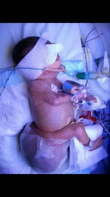 Aleyathiah Wilcockson was born weighing 900 grams with a 1.2-kilogram tumour below her tailbone Photo: Supplied
