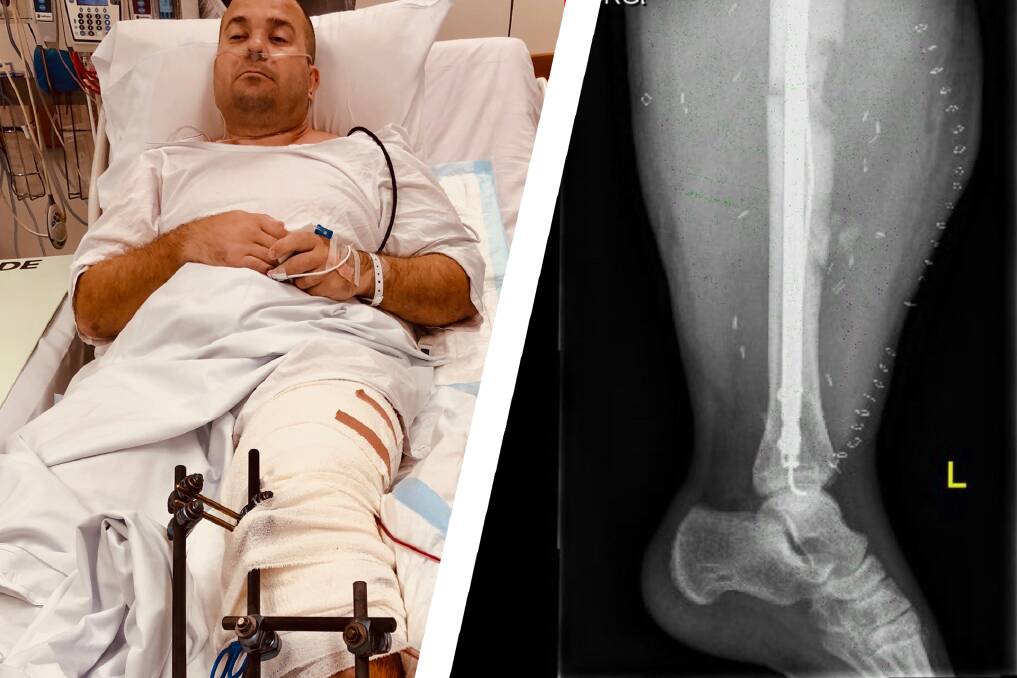 Bill Springett-Kelly in St Vincent's Hospital and an X-ray of his heavily swollen left leg, complete with titanium rods and screws, after the collision. Photo: Bill Springett-Kelly
