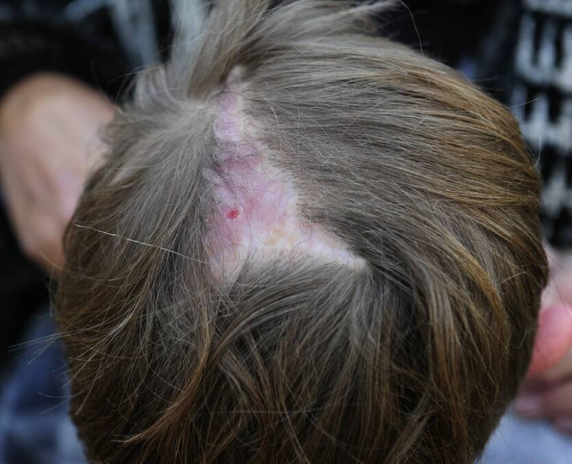 Dog attack victim Jack Hartigan shows the injuries to his scalp.  Photo: Melissa Adams 