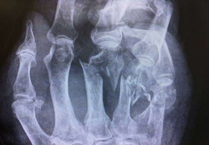 An x-ray of a hand which was saved by maggots. Source: ACT Health Directorate. Photo: Supplied