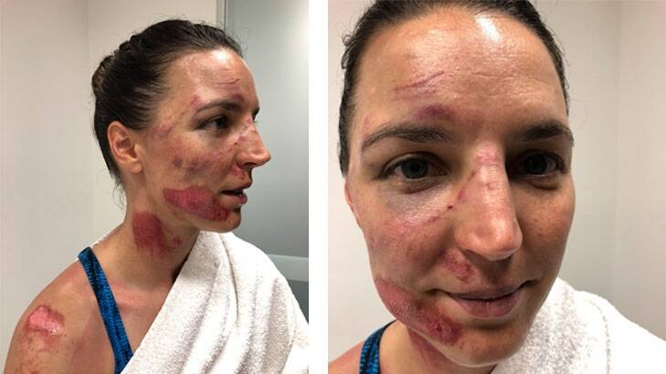Rebecca Wiasak had plenty of scars after her last attempt at the Tour Down Under. Photo: Supplied