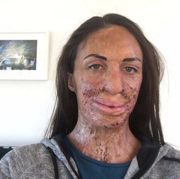 Turia Pitt had undergone more surgery for the injuries she sustained during an ultra marathon in 2011. Photo: Instagram