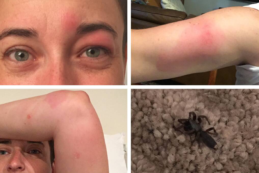 The extensive swelling was the tell-tale sign of another spider bite. Photo: Fleta Page