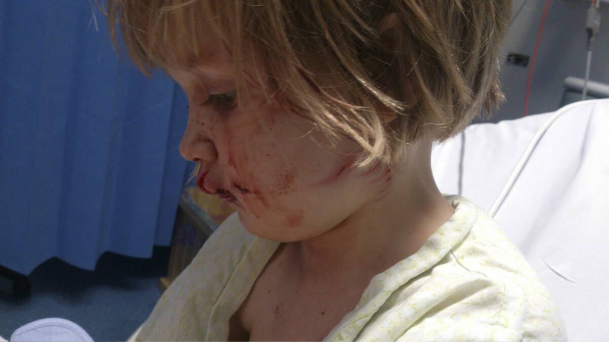 Phoebe Hettinger was bitten on the face – leaving her scarred. Photo: Supplied