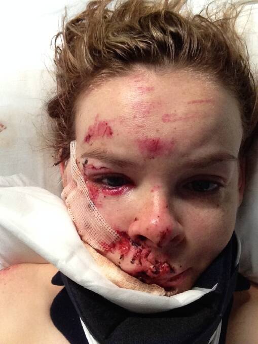 Michelle Weir's facial injuries as seen the day after her April 2015 cycling accident. Photo: Supplied