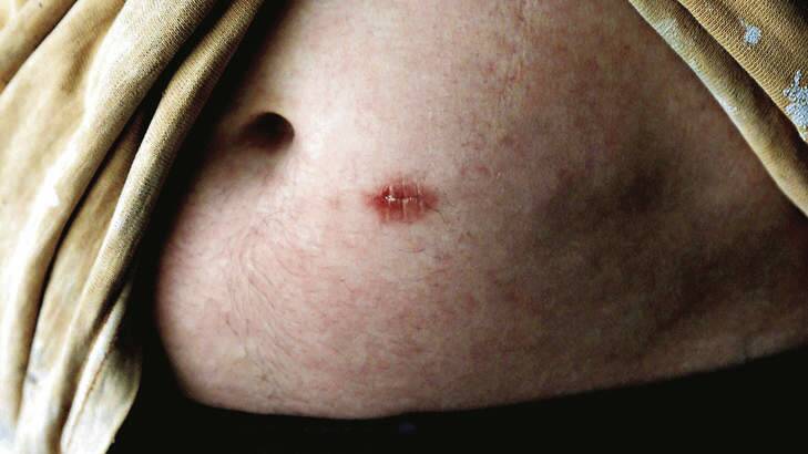 A man with a Naltrexone implant in his stomach. Photo: Supplied