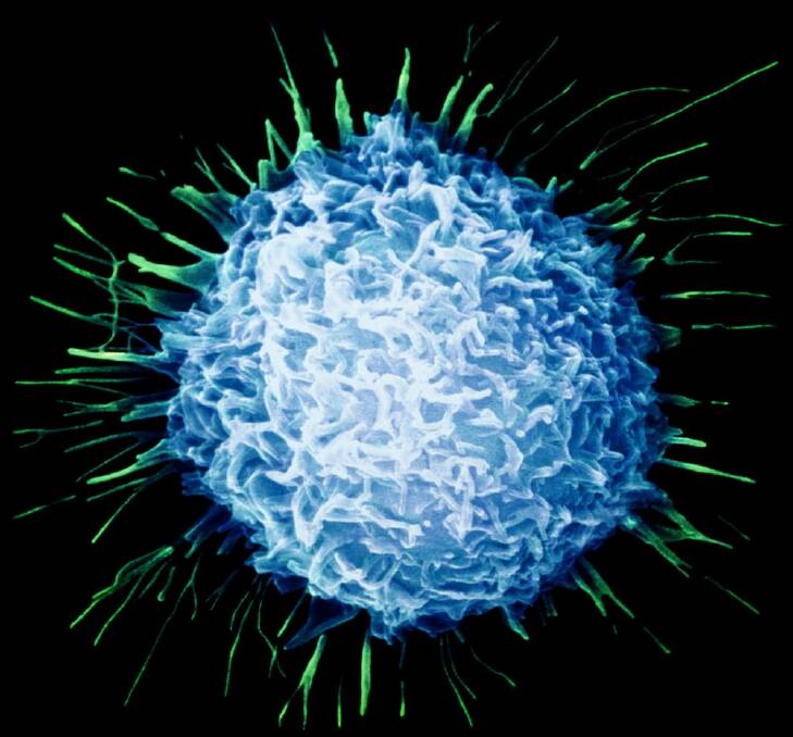 Image of a prostate cancer cell. Researchers say there is no need to use the 'c' word at the merest hint of cell change. Photo: Not for syndication