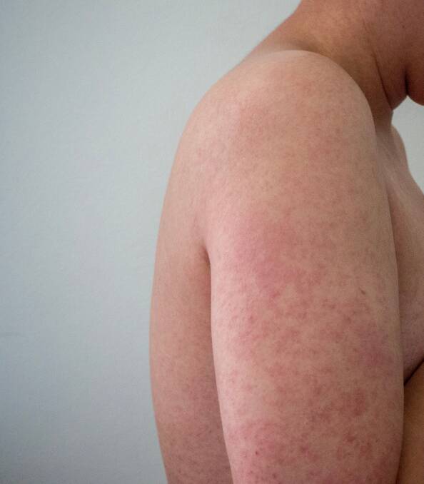 A man suffering from measles. Photo: Shutterstock