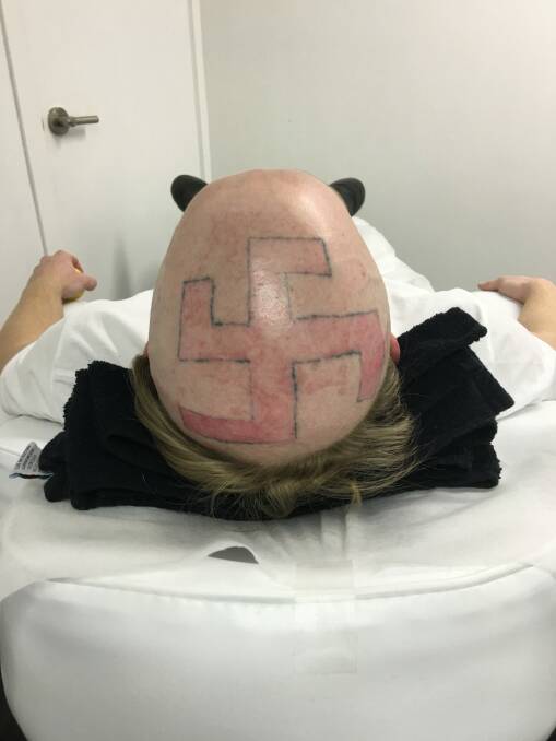 One man visited Expired Laser Studio after his friends tattooed a swastiska on his head as a prank.
