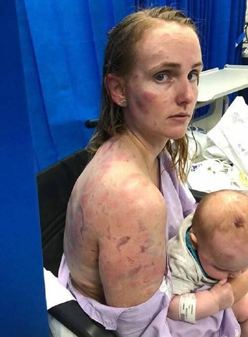 Kingaroy mother Fiona Simpson shielded her daughter as they were hammered by hail. Photo: Facebook