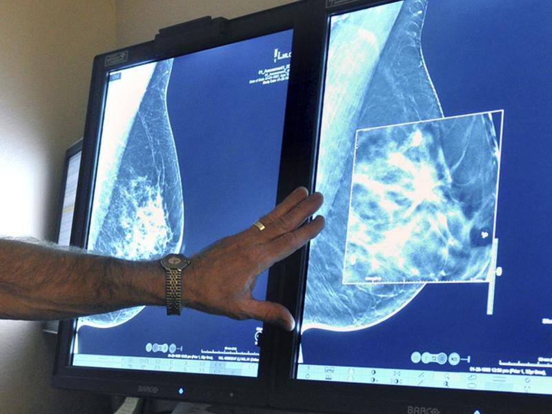 A study has shown suspending screening for breast cancer during COVID-19 did not lead to more cases. (AP PHOTO)