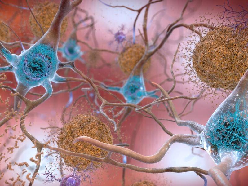 New the findings may have important implications for understanding and treating Alzheimer's disease. (AP PHOTO)