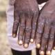 A WHO official says putting measures in place quickly will easily contain a monkeypox outbreak.