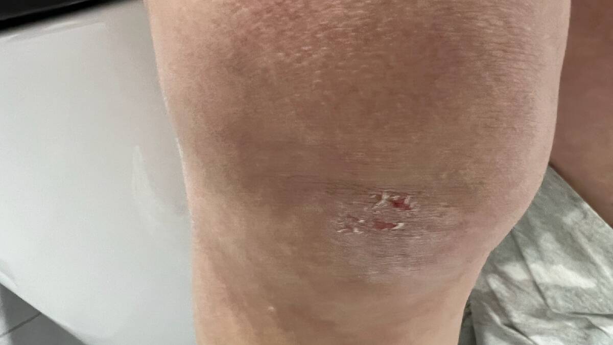 The victim's knee after the alleged attack.