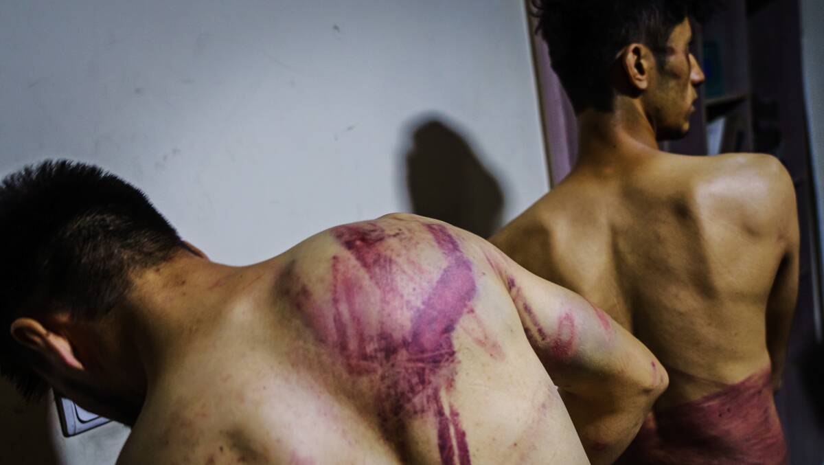 Journalists Nemat Naqdi, 28, and Taqi Daryabi, 22, show wounds they sustained when Taliban fighters tortured and beat them for reporting on a women's rights protest in Kabul on September 8. Picture: Getty Images