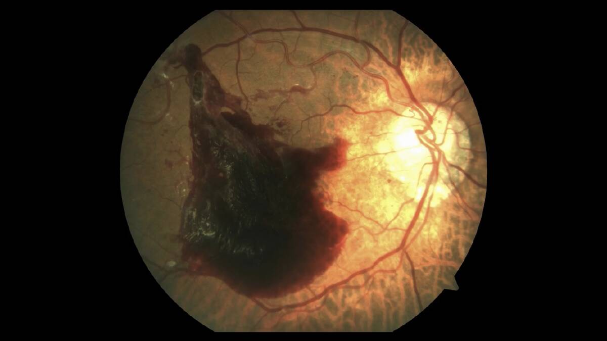 Persistent high levels of glucose and insulin in the blood will in time damage the fine blood vessels throughout the body, resulting in conditions such as blindness. 