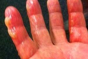 The image placed on Shane Warne's Twitter site, supposedly showing his burnt bowling hand. Photo: Twitter